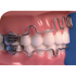 Lip Bumper Lower Large
