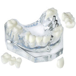 3 Unit Bridge On 3 Implants & Single Crown On 1 Implant & 3 Unit Natural Bridge