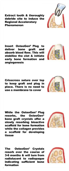 オステオ ゲン プラグ OsteoGen Plug Slim 6 x 25mm (5個入り)